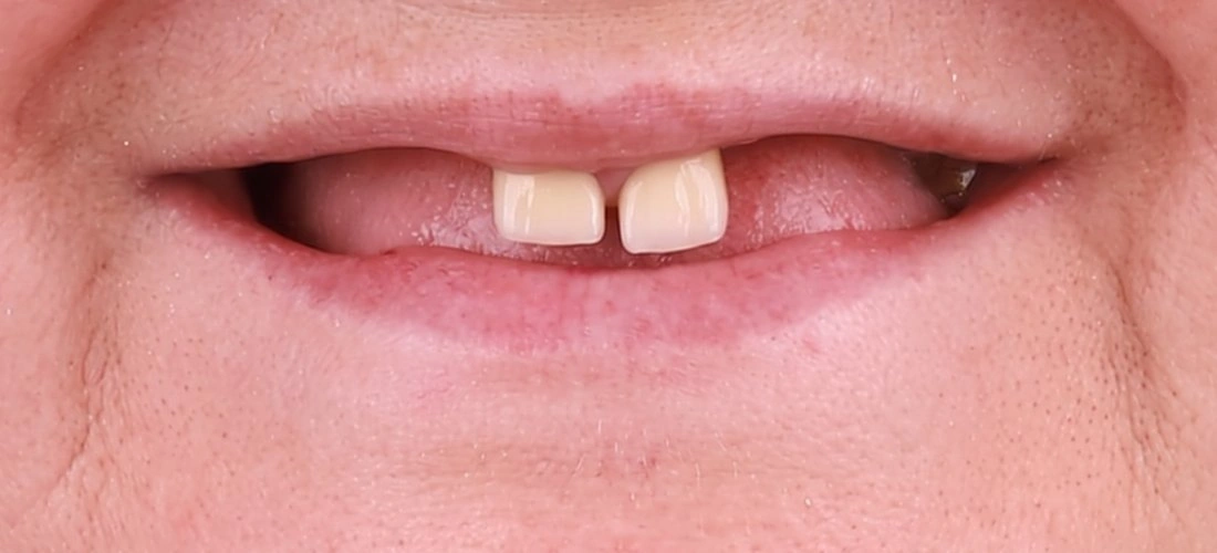 Przed leczeniem — dwa pozostałe zęby przednie w szczęce