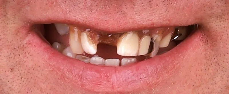 Dental implants before surgery — Dr Sawicki Warsaw