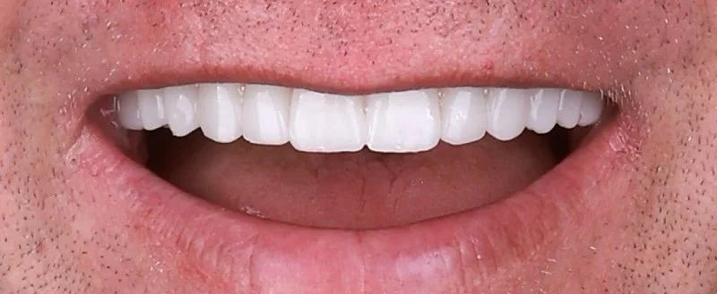 Implantology treatment results after surgery — Dr Sawicki Warsaw