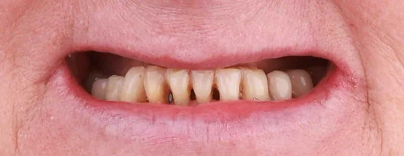 Dental implants before surgery — Dr Sawicki Warsaw