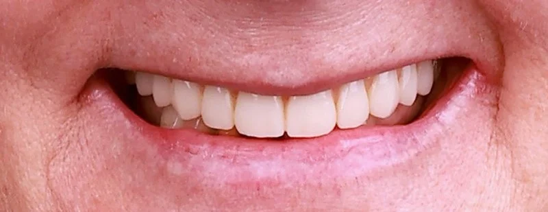 Implantology treatment results after surgery — Dr Sawicki Warsaw