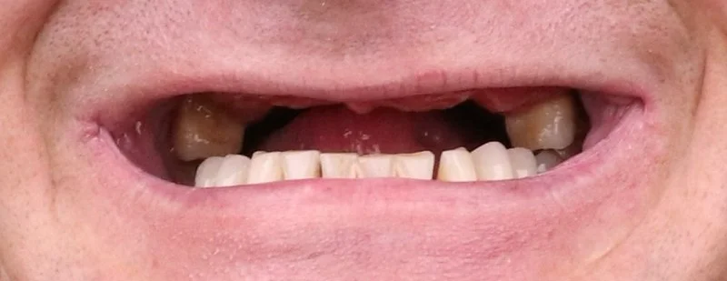 Dental implants before surgery — Dr Sawicki Warsaw