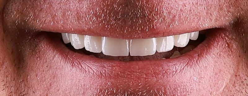 Efekty leczenia implantologicznego po zabiegu — dr Sawicki Warszawa