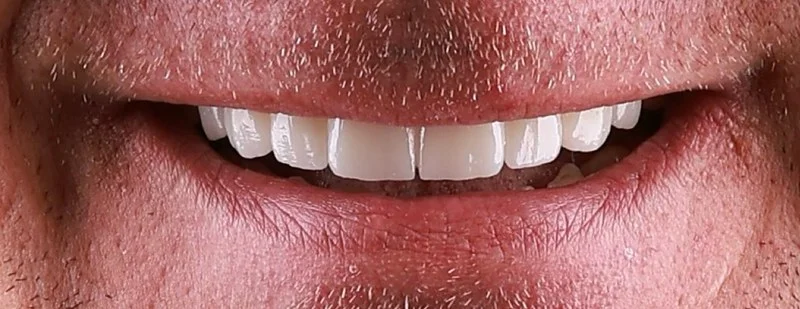 Implantology treatment results after surgery — Dr Sawicki Warsaw