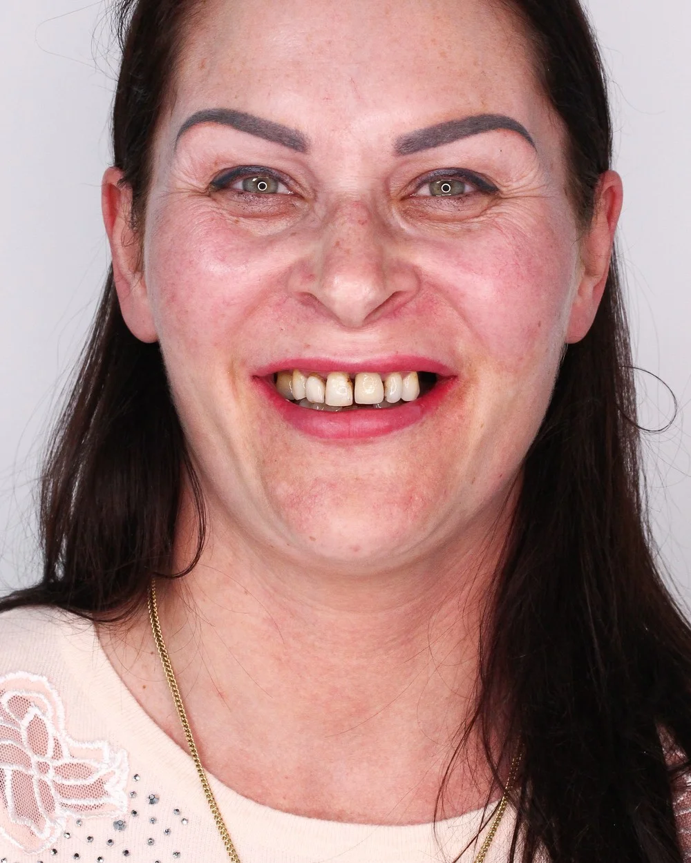 All on 4 treatment results before surgery — full arch reconstruction