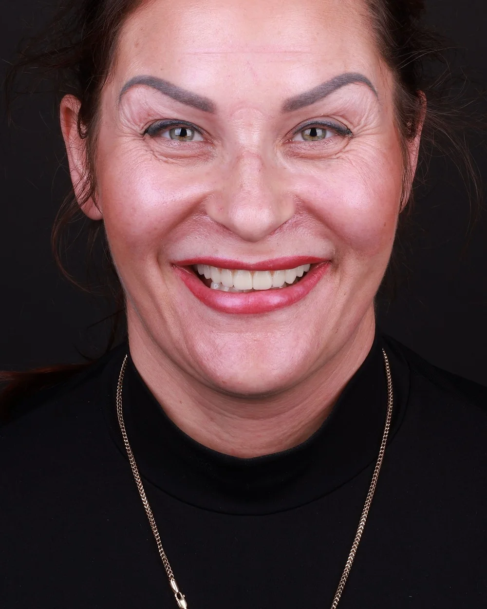 All on 4 treatment results after surgery — teeth in one day