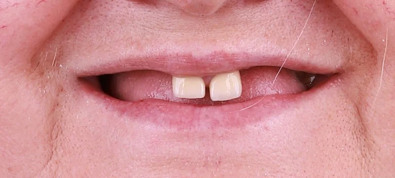 Dental implants before surgery — Dr Sawicki Warsaw