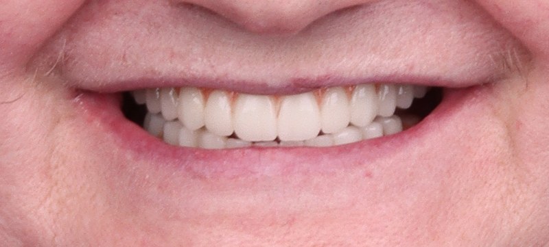 Efekty leczenia implantologicznego po zabiegu — dr Sawicki Warszawa