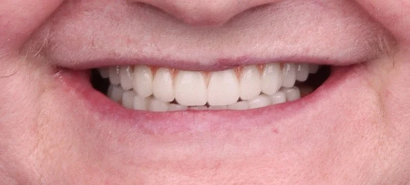 Implantology treatment results after surgery — Dr Sawicki Warsaw