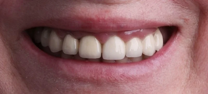 Dental implants before surgery — Dr Sawicki Warsaw
