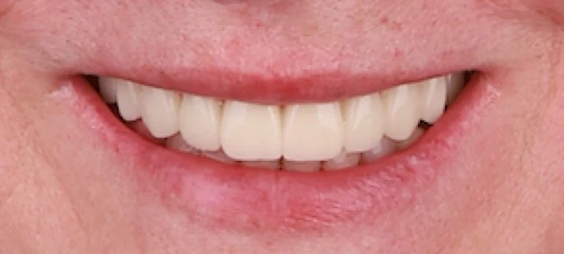 Implantology treatment results after surgery — Dr Sawicki Warsaw